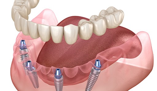 Illustration of implants in lower arch to anchor all-on-4 dentures