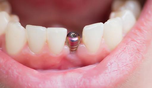 Dental implant before receiving restoration